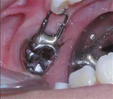 Steel Tooth