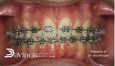 Steel Tooth